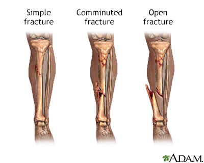 Bone fracture repair - series | Health Encyclopedia