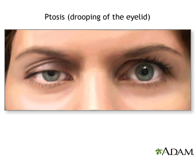Ptosis, drooping of the eyelid