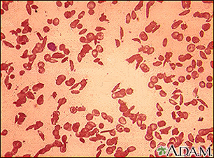 Red blood cells, sickle cells
