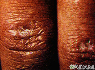 Dermatomyositis, Gottron papule
