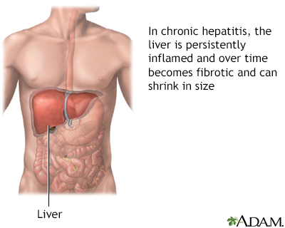 Aggressive hepatitis