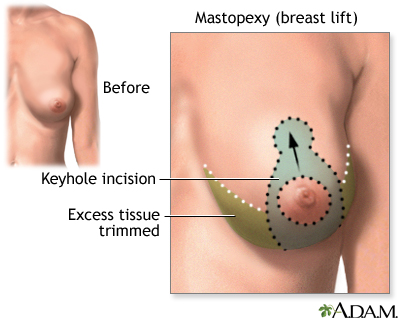 loss of sensation after breast lift Asian maid nude
