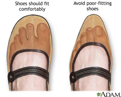 Proper fitting shoes