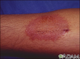 Dermatitis, contact