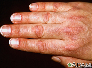 Dermatomyositis, Gottron papule