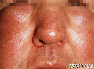 Edema, central on the face