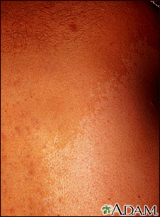 Neurofibromatosis, giant cafe-au-lait spot