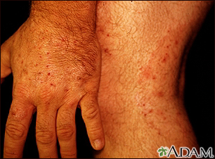 Ringworm, tinea on the hand and leg