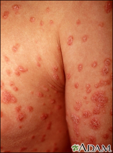 Psoriasis, guttate on the arms and chest