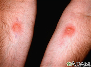 Skin testing, PPD (R arm) and Candida (L)