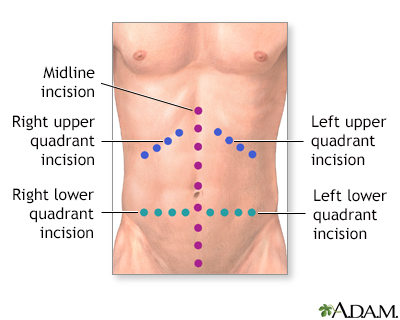 Abdominal exploration - series | Health Encyclopedia ... lower abdominal incision diagram 