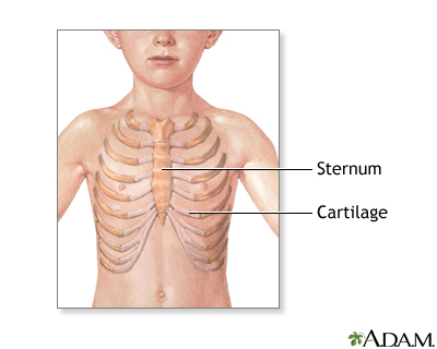 breast bone deformity Breast bone deformity